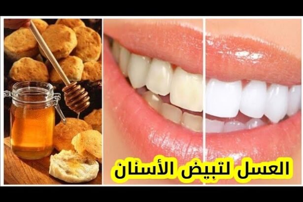 عسل النحل لتبييض الأسنان